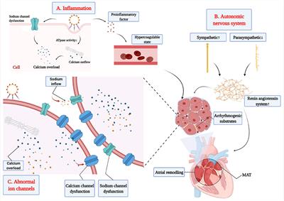 Progress of Pathogenesis in Pediatric Multifocal Atrial Tachycardia